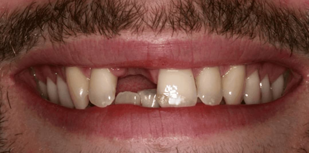 Missing Teeth