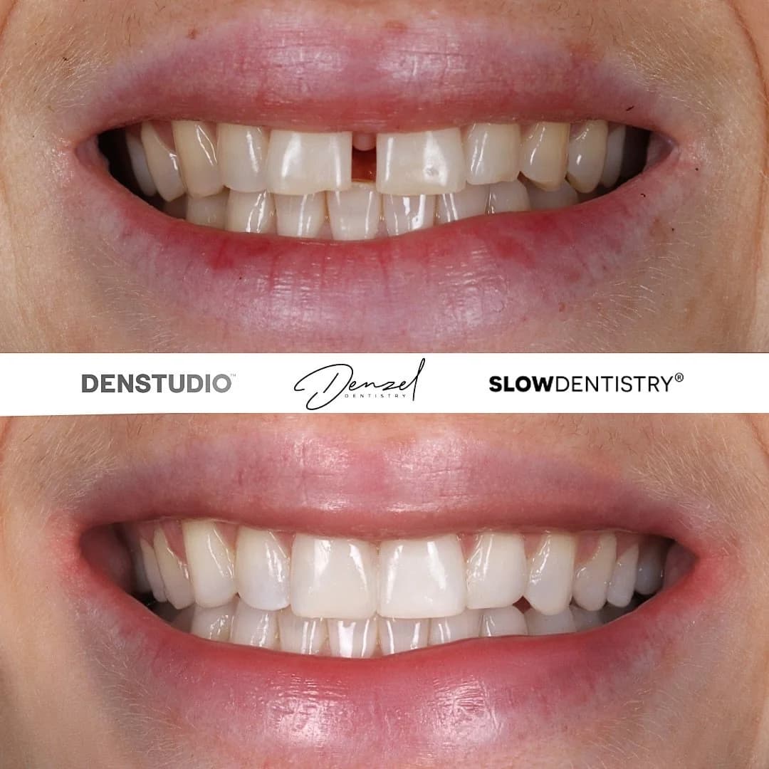 Patient smile transformation