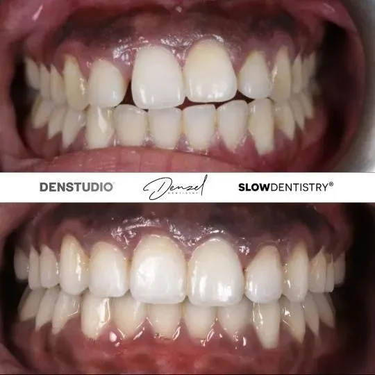 Before and after smile transformation