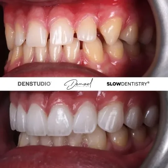 Veneers and bonding result