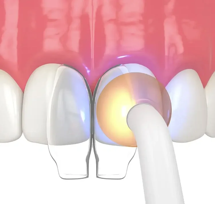 Composite Bonding for Gummy Smiles
