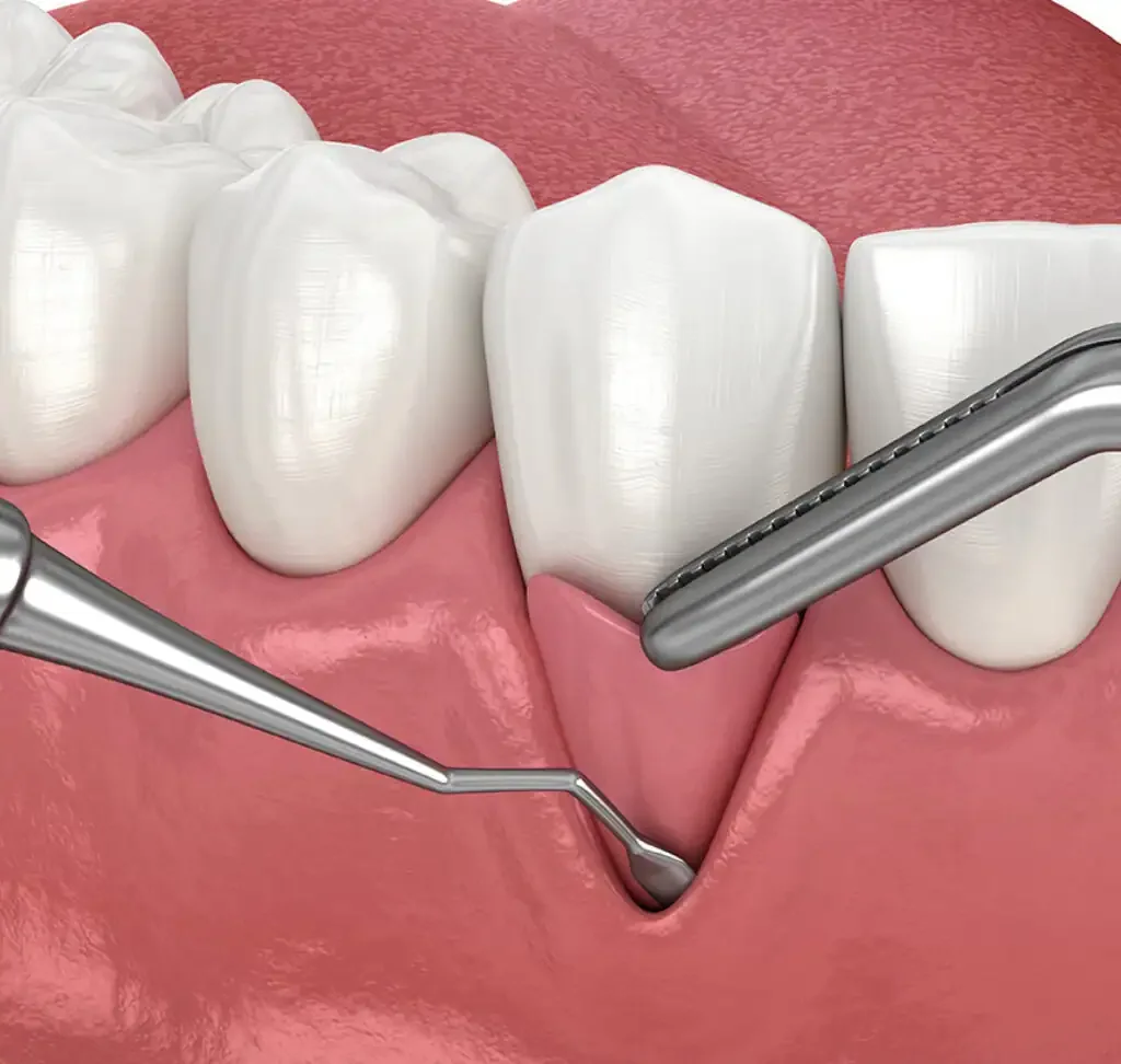 Surgical Gum Lift and Contouring