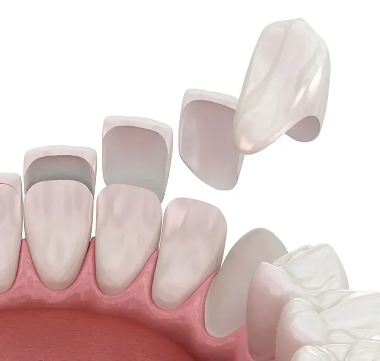 Veneers for Gummy Smiles