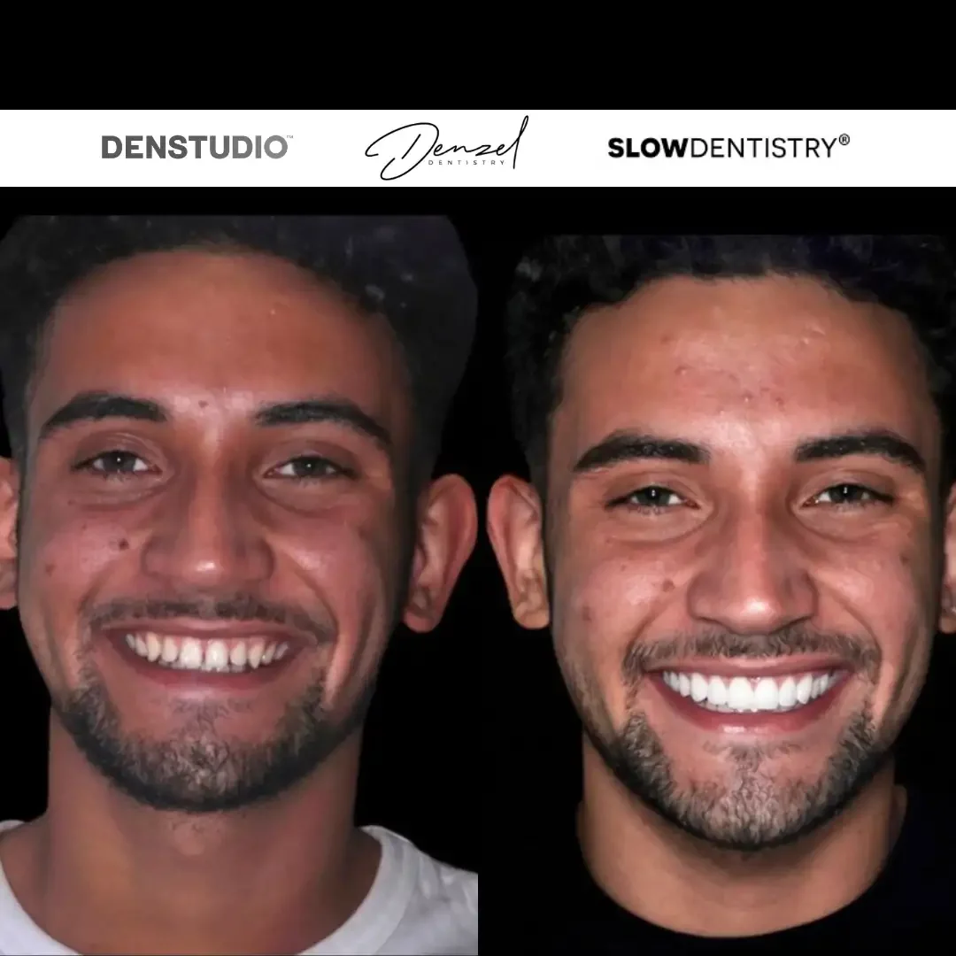 Smile transformation result