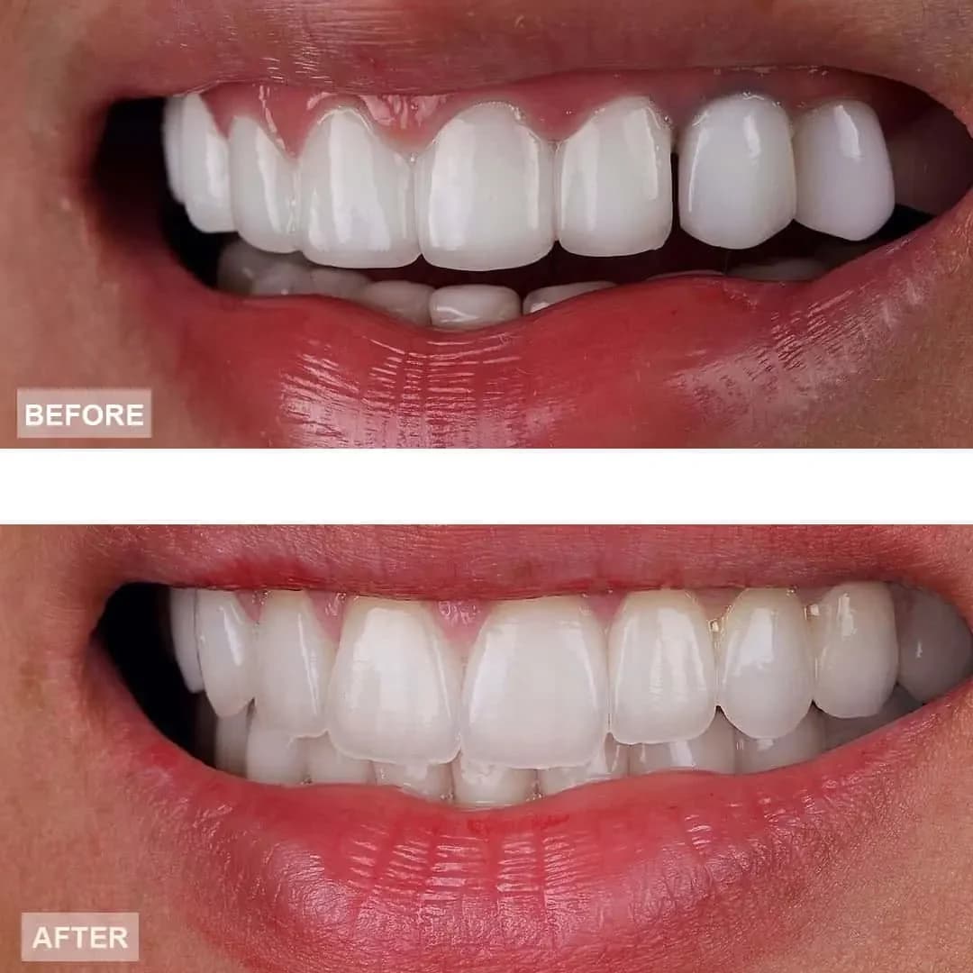 Porcelain Veneers