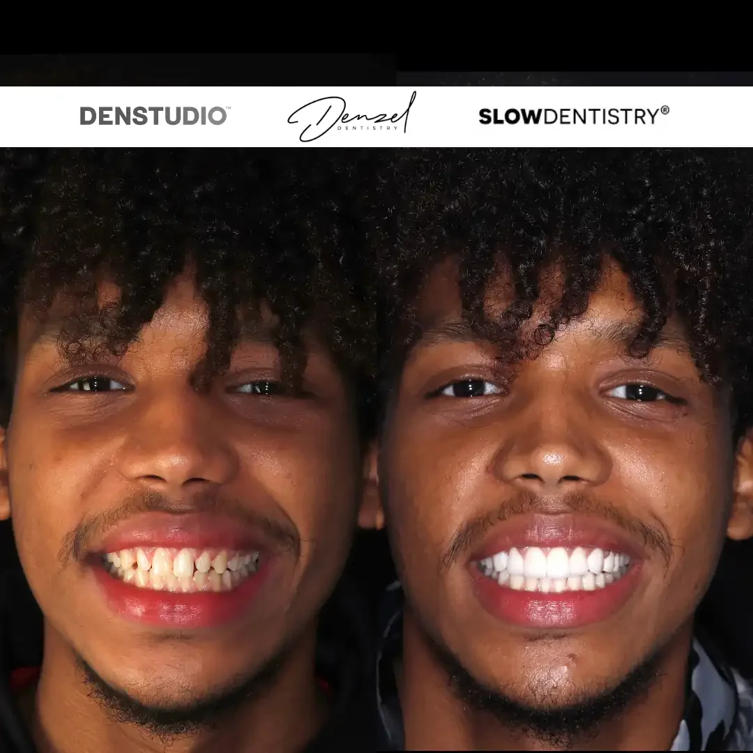 Porcelain veneers clinical result — before and after