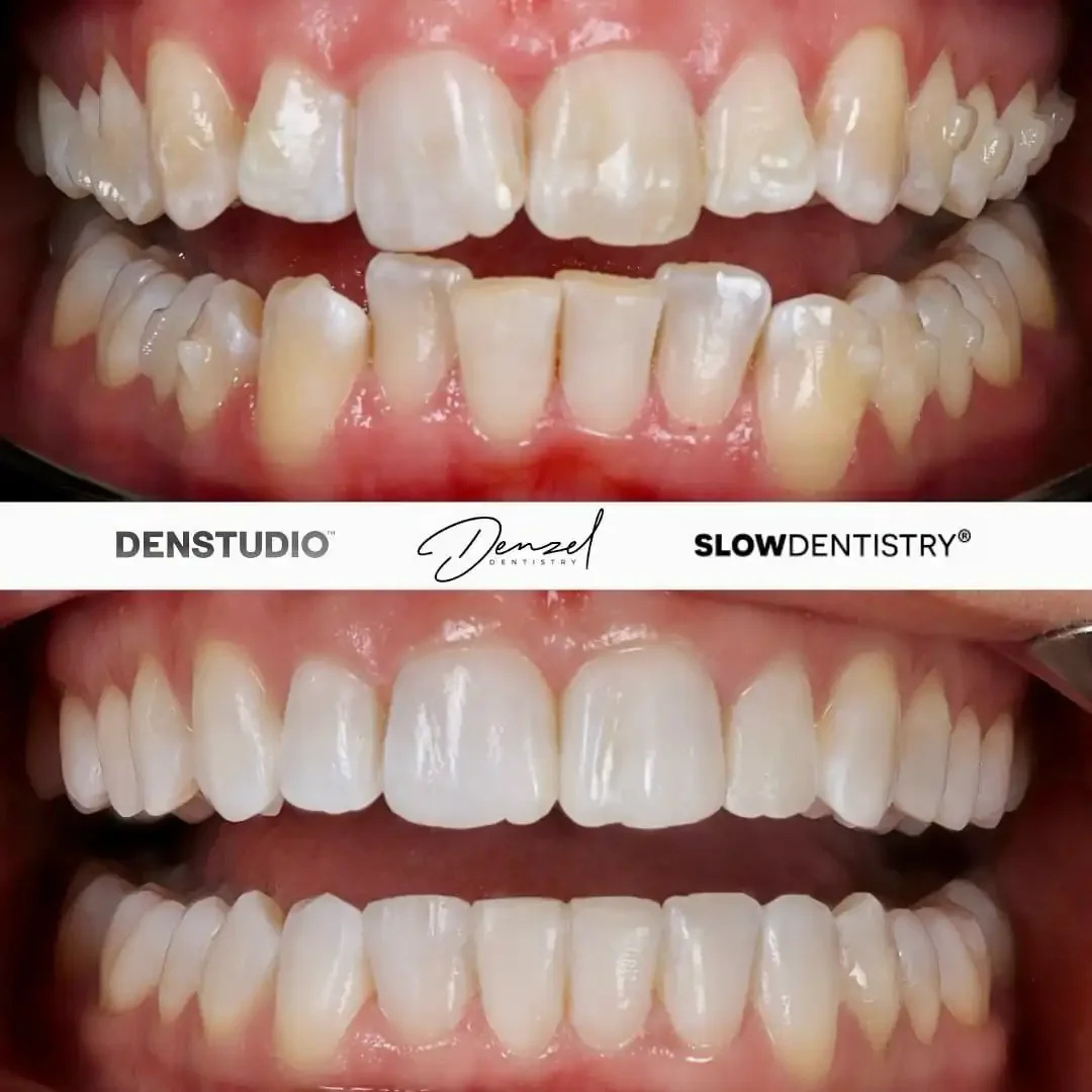 Invisalign before and after 1