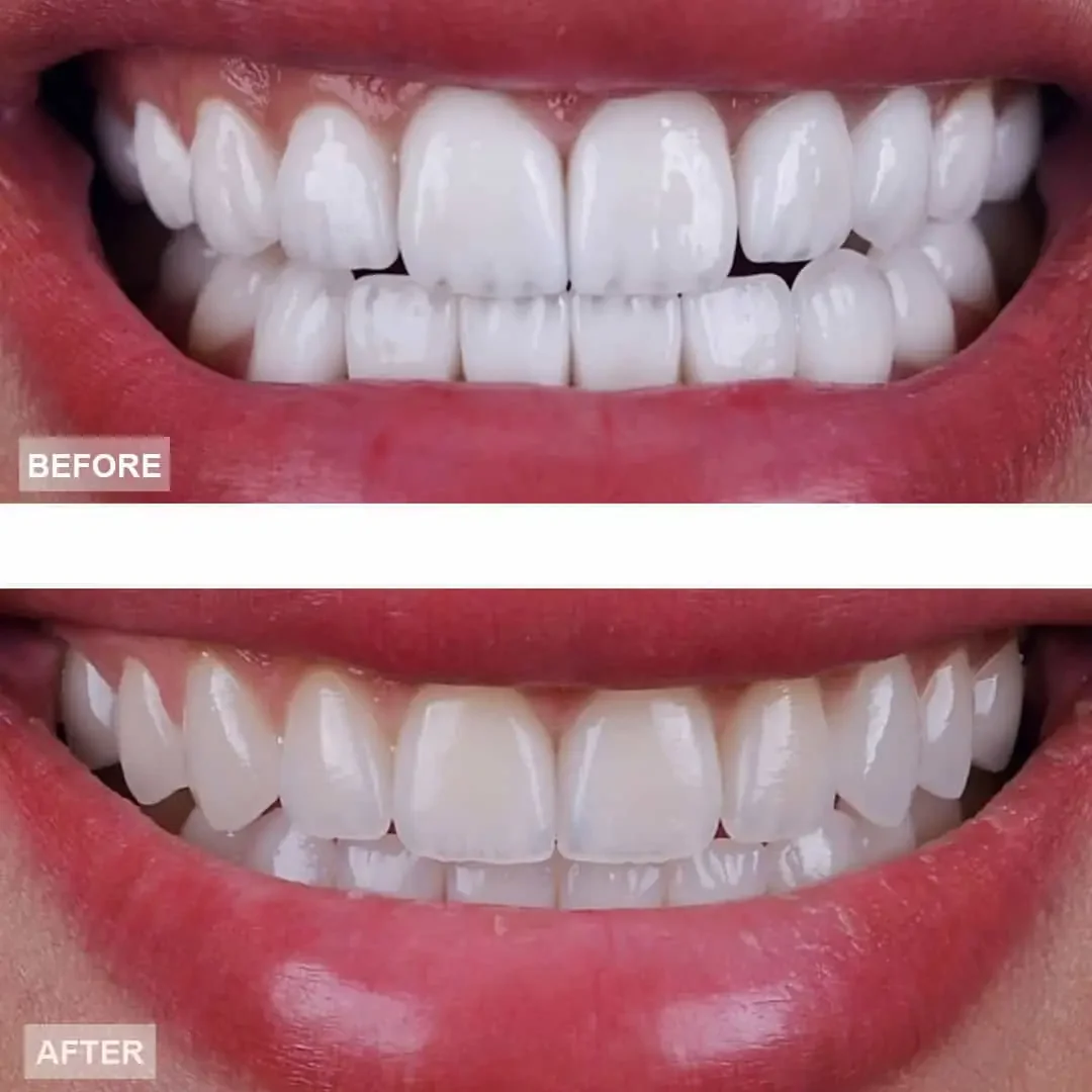 Smile transformation — before and after
