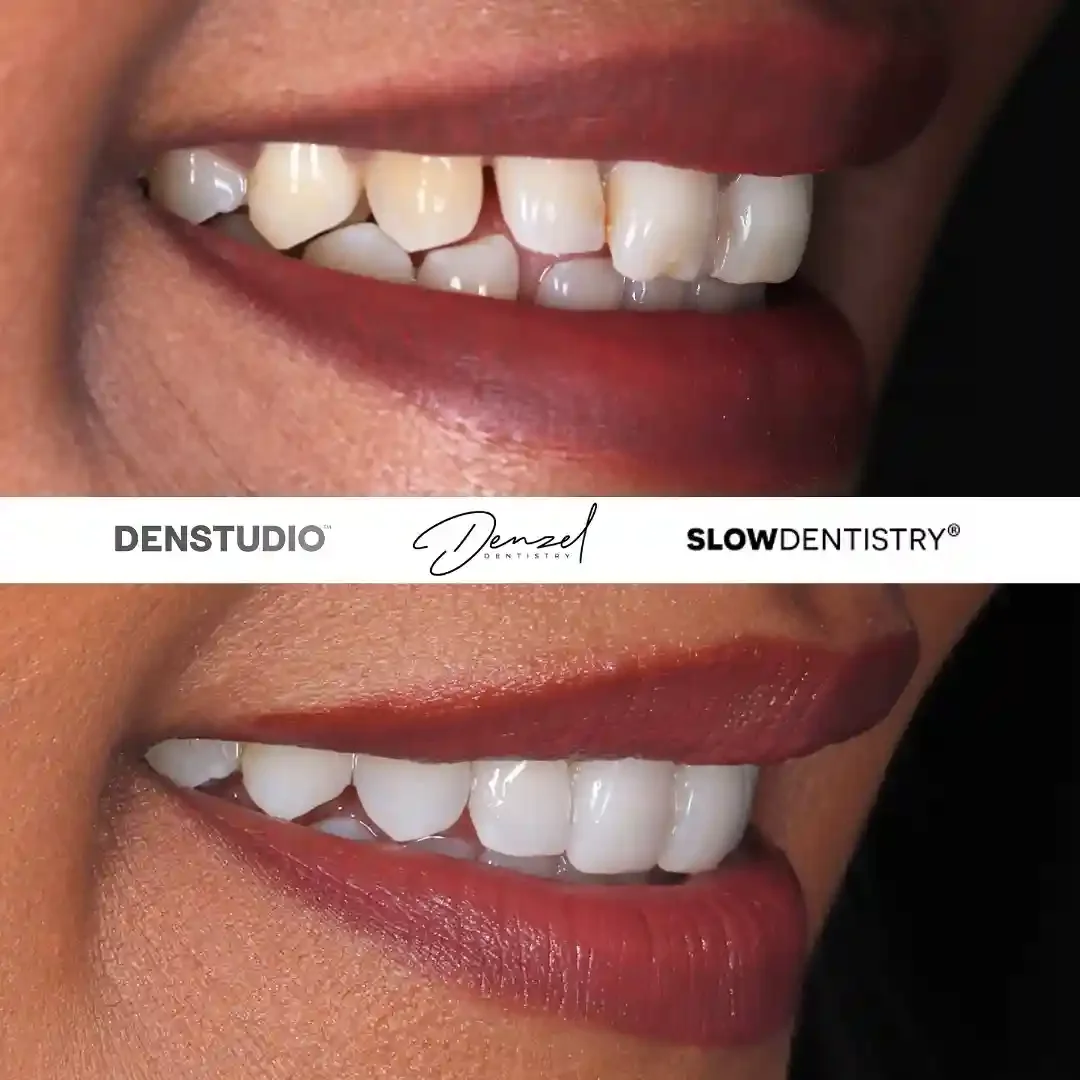 Composite bonding patient result 1