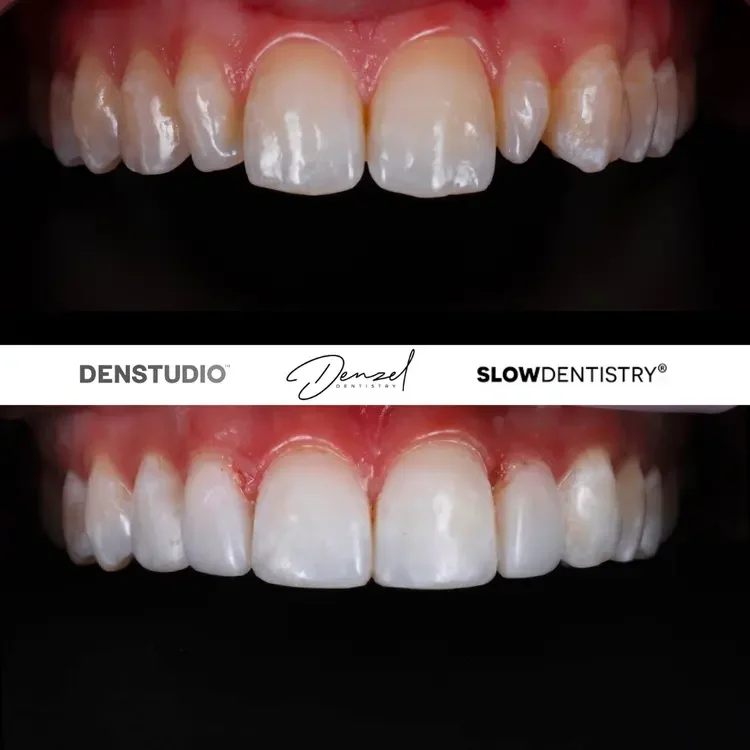 Composite bonding patient result 3
