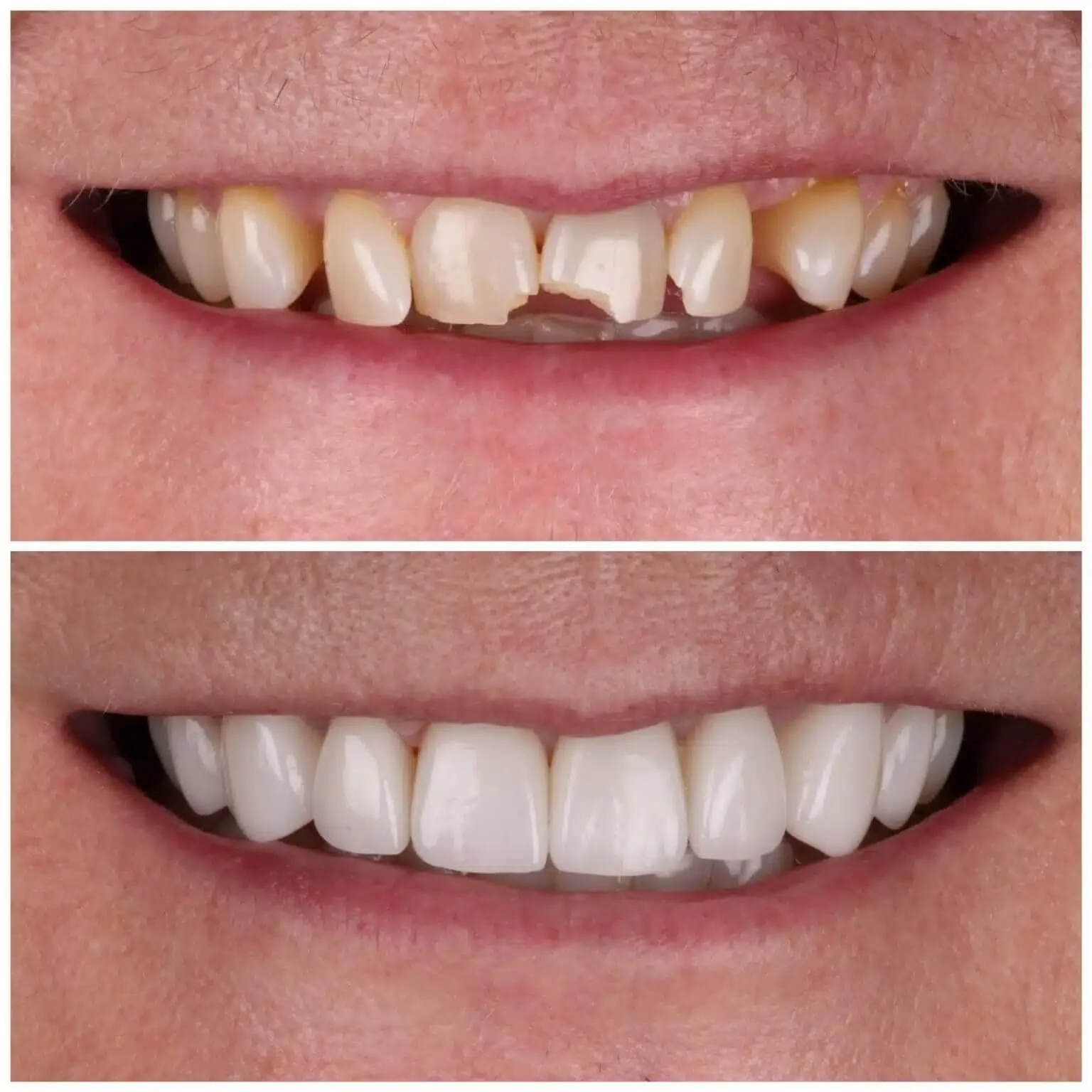 Chipped & Broken Teeth