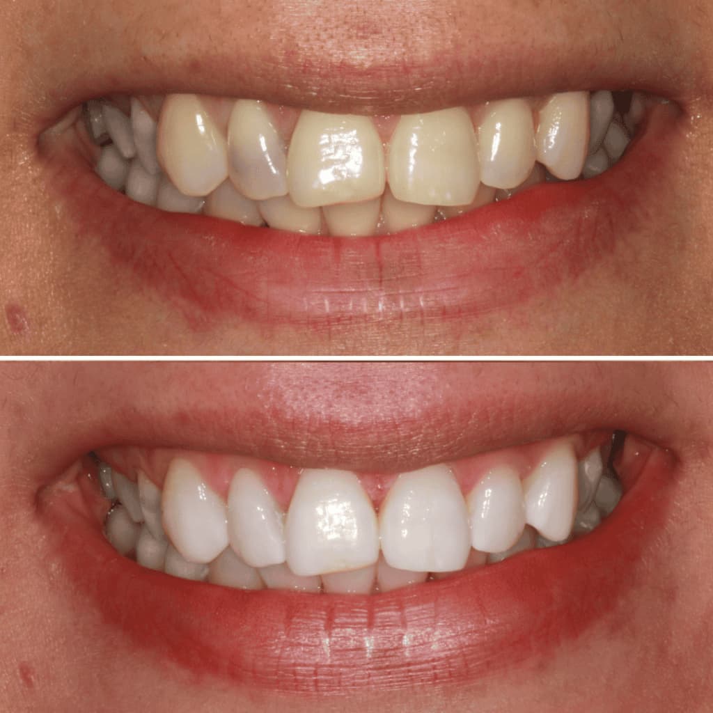 Misaligned & Crowded Teeth
