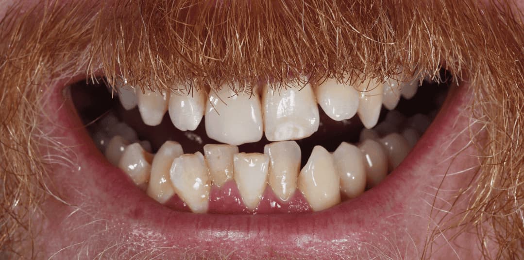 Misaligned & Crowded Teeth