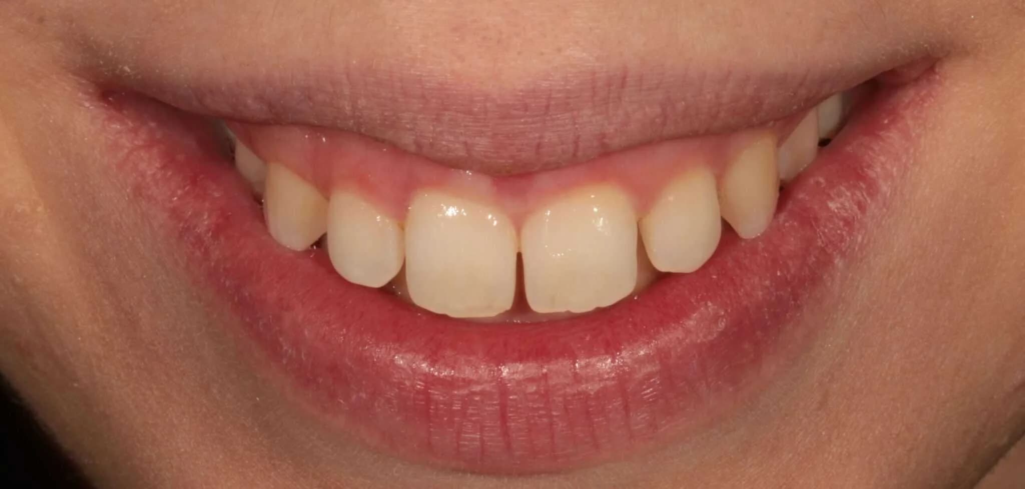 Tooth Discolouration