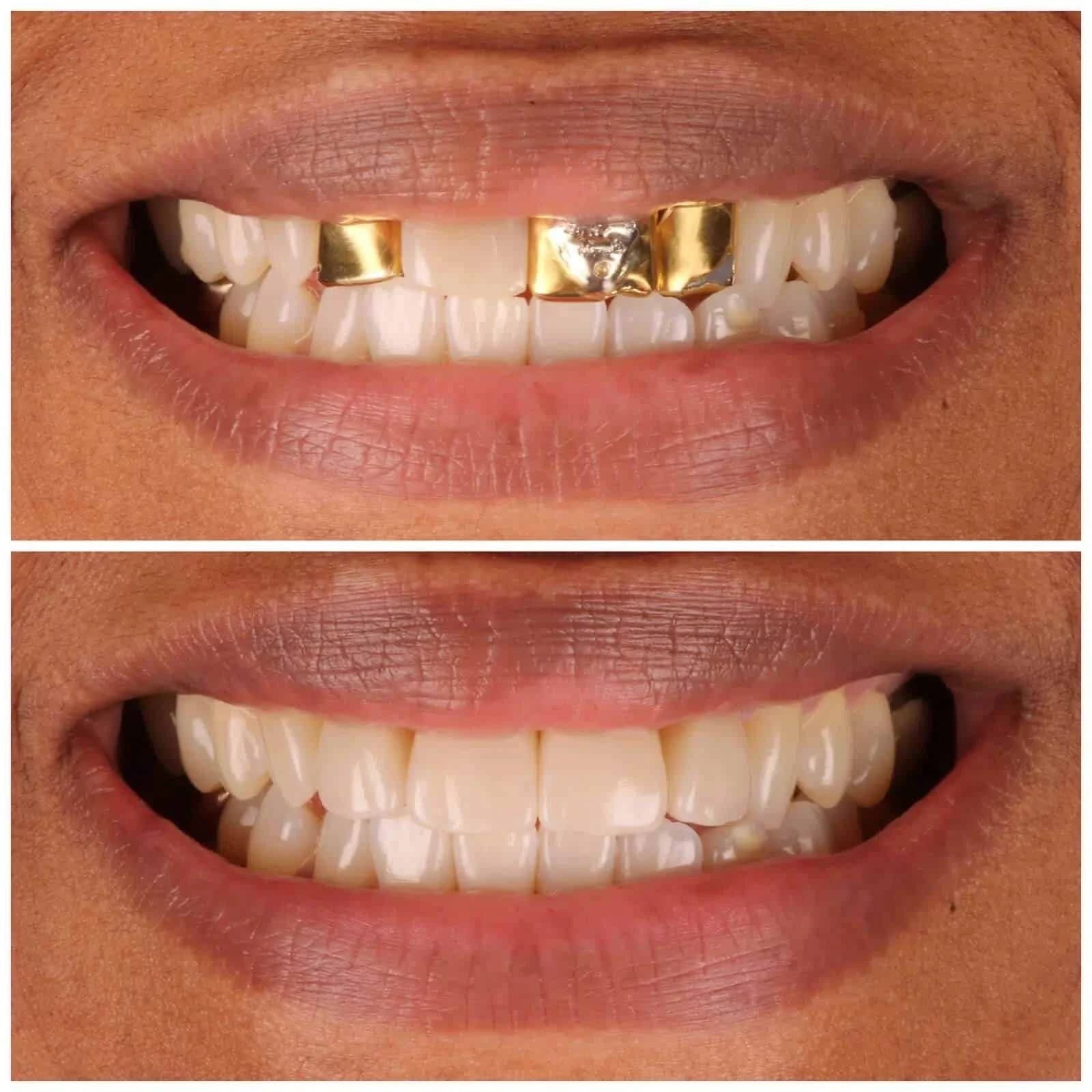 Replace Metal Veneers & Crowns