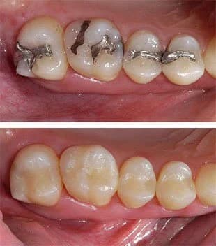 Replace Metal Fillings