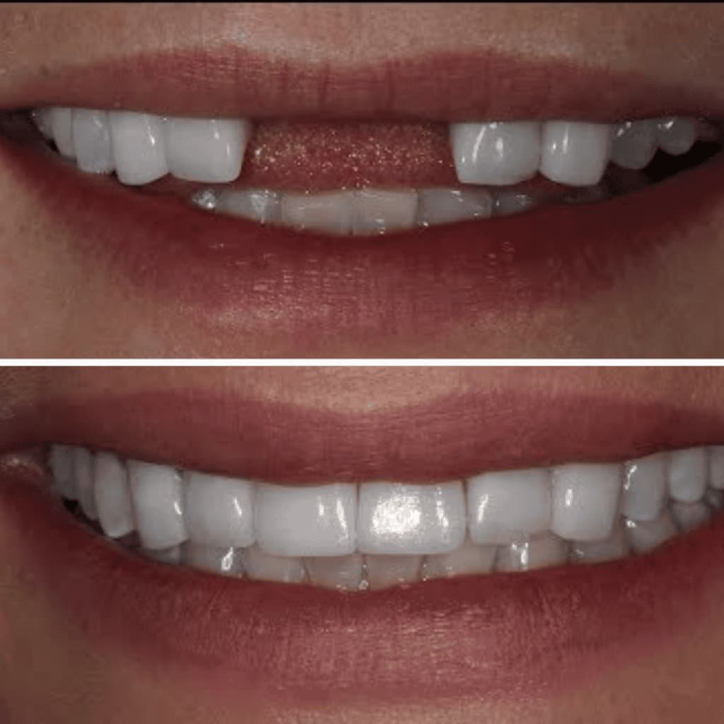 Missing Teeth