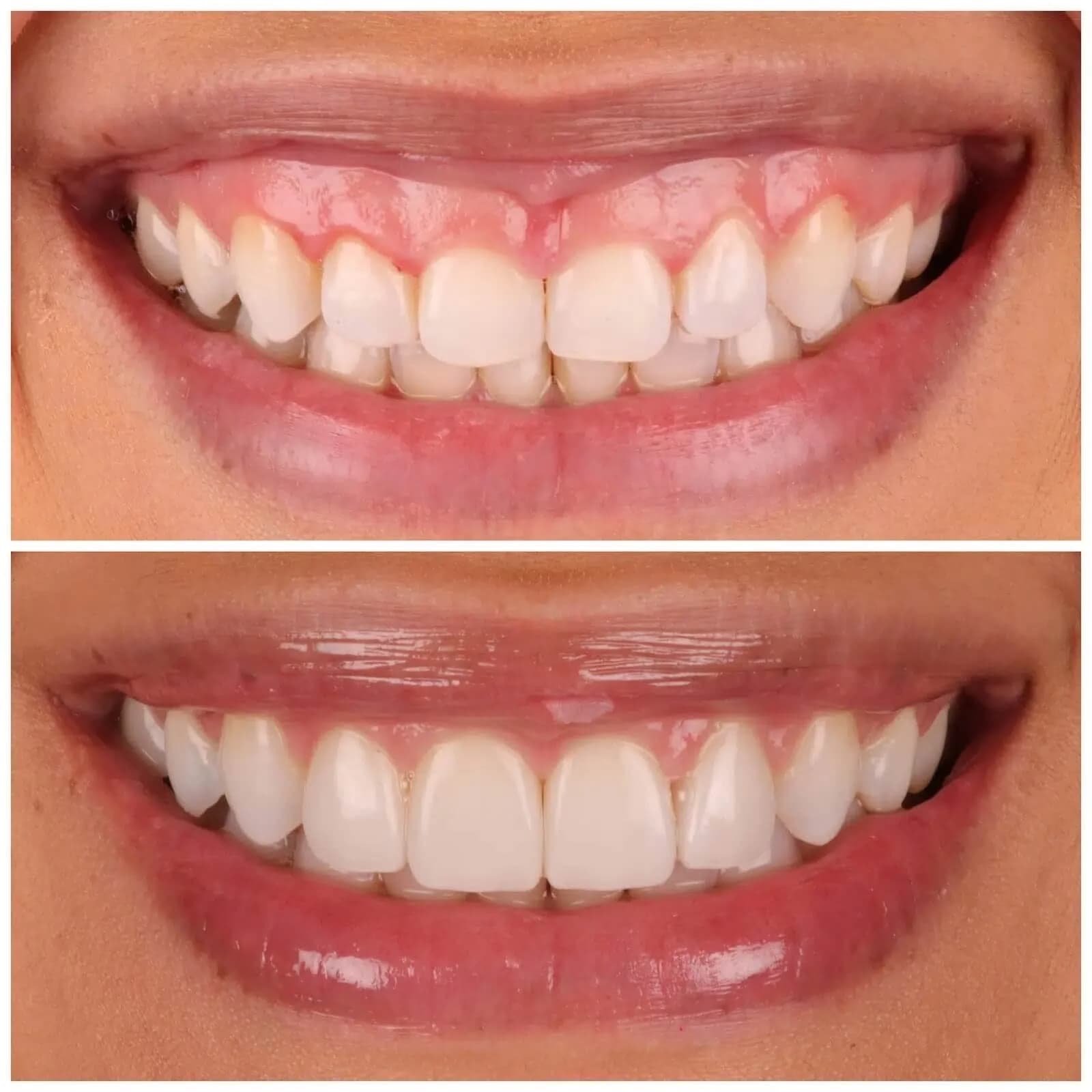 Gummy Smile