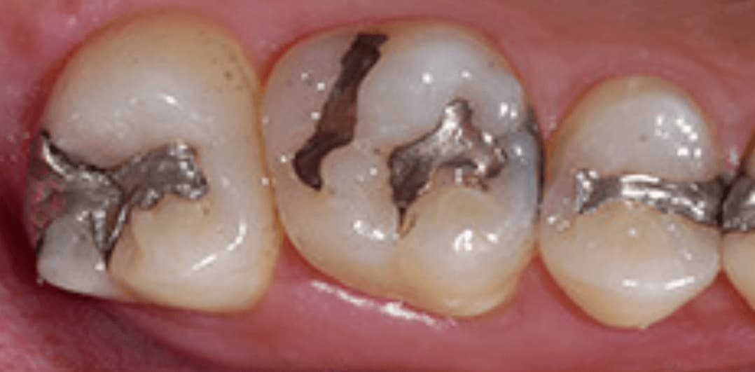 Replace Metal Fillings