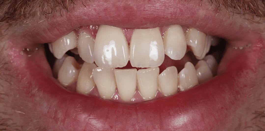 Misshapen Teeth