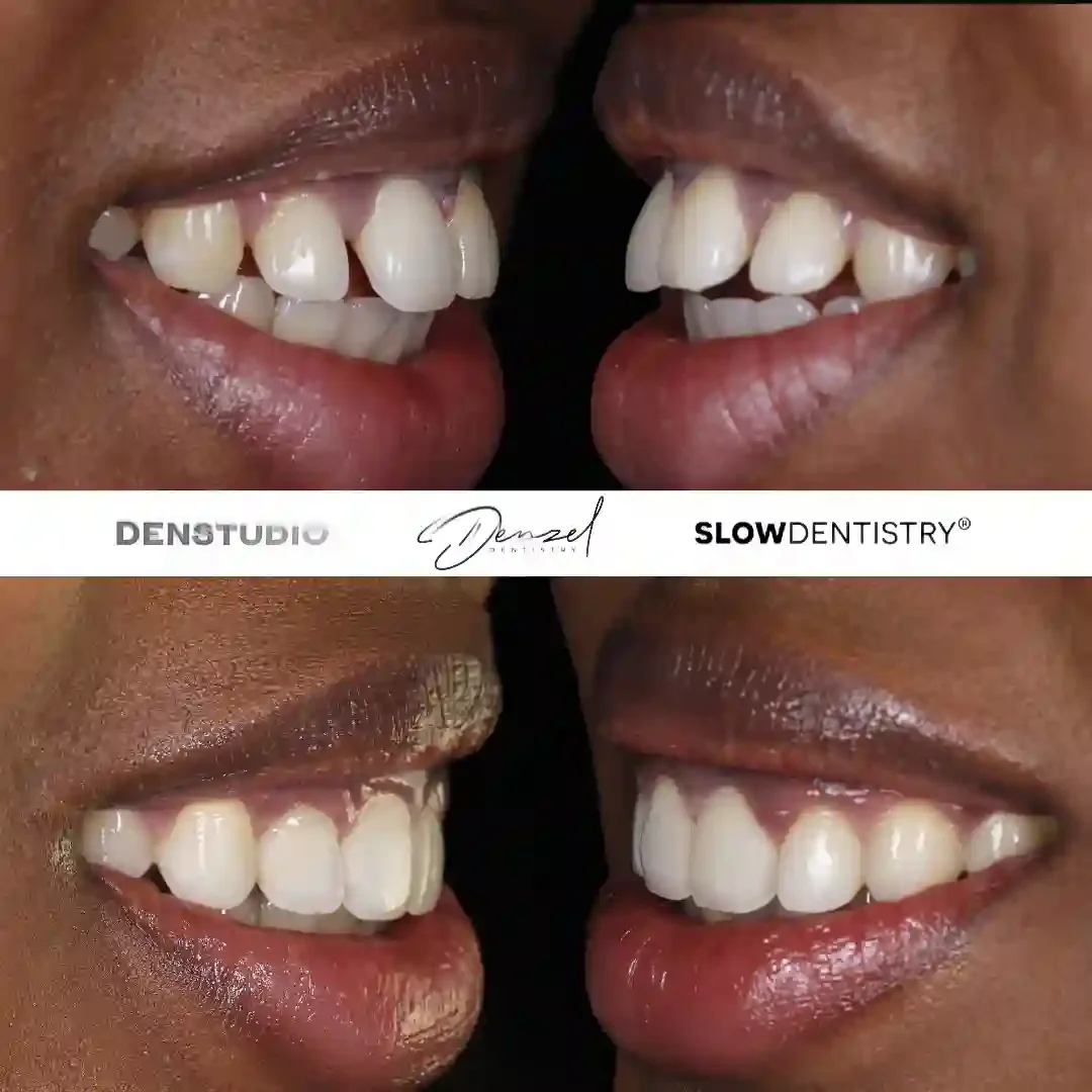 Invisalign teeth straightening result