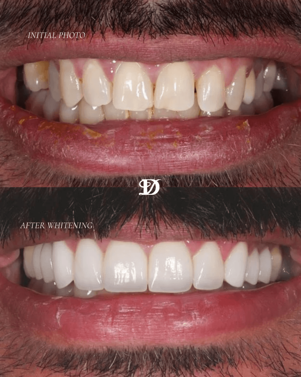 Whitening results, before and after