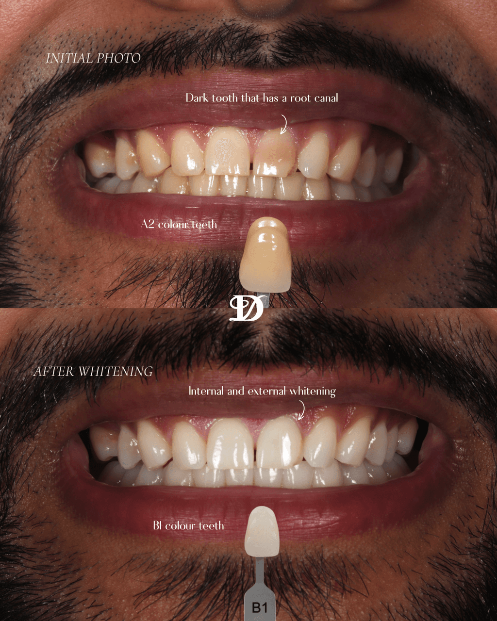 Internal and external whitening, before and after