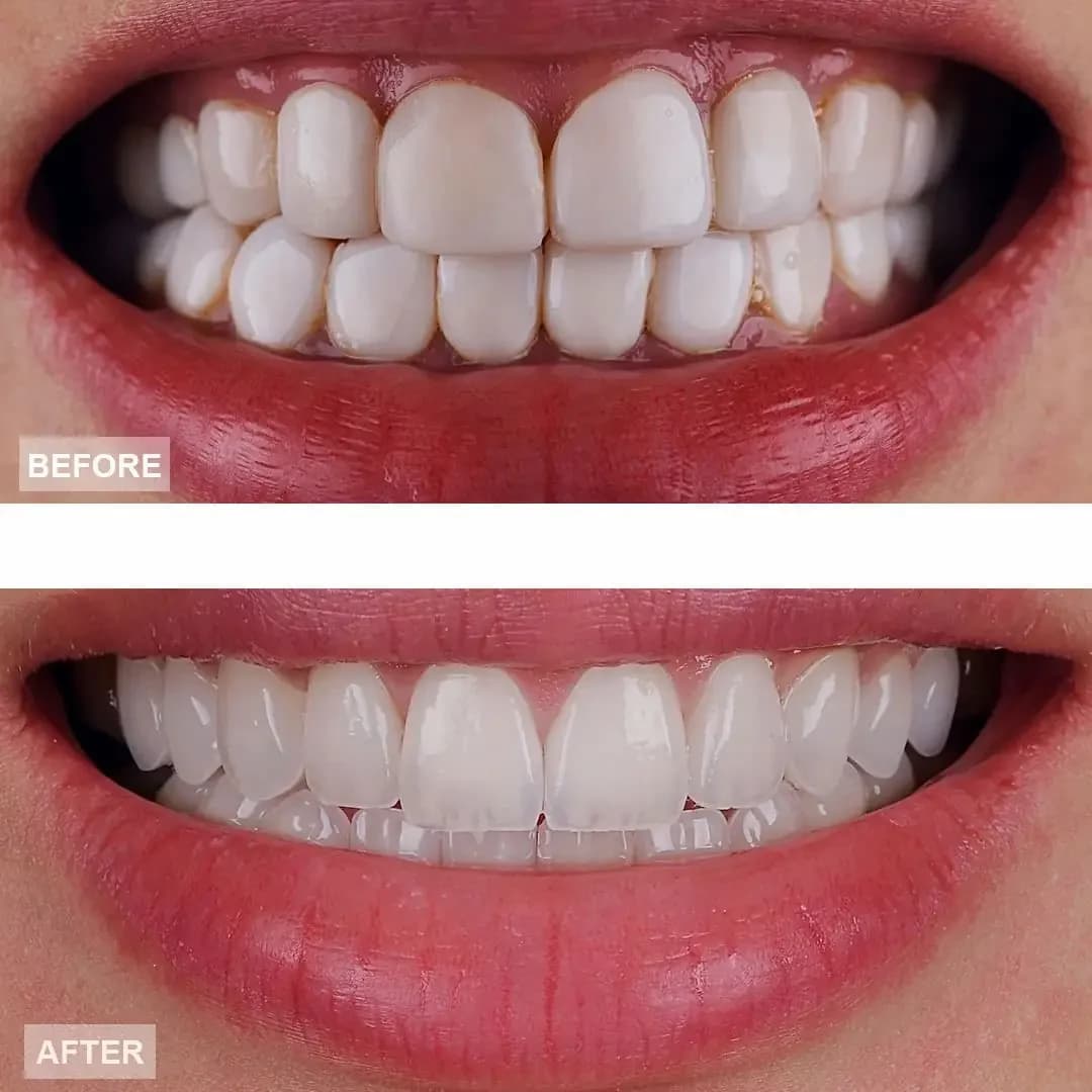 Professional whitening — before and after