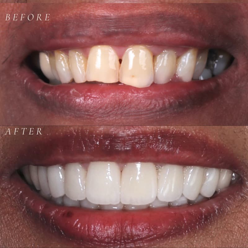Veneer transformation — before and after
