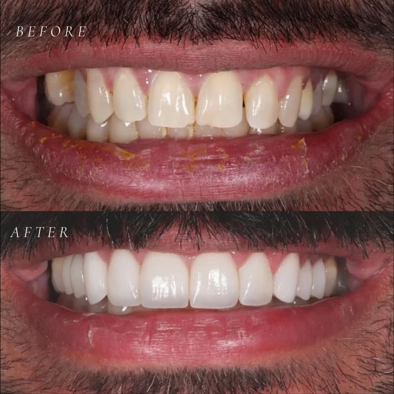 Smile makeover with porcelain veneers — before and after