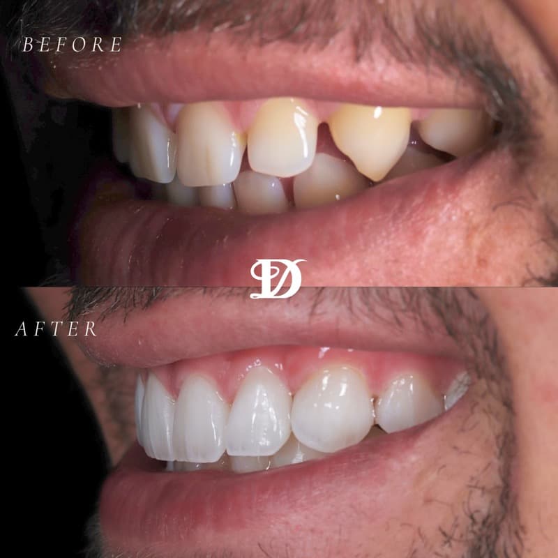 Porcelain veneers — before and after